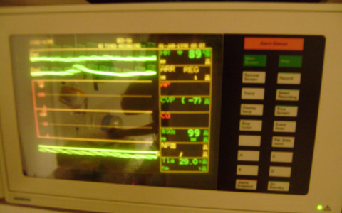 Pacientský monitor sledující průběh anestezie